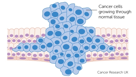 What Is Cancer