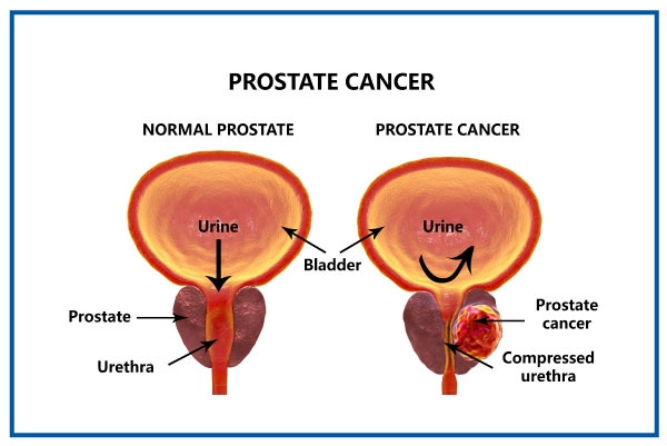 What Is Prostate Cancer What Is Prostate Cancer